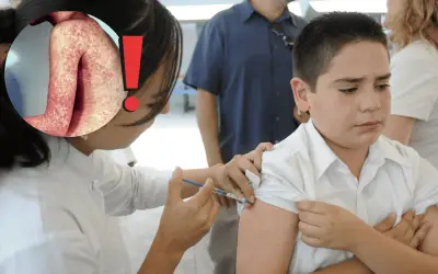 Brote de Sarampión en México: 90% de los Infectados No Están Vacunados