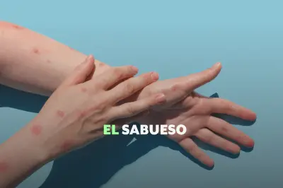 Brote de Sarampión en México: Casos Superan los 9,400 y Expertos Alertan sobre Contagio