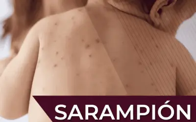 Brugada Pide Evitar Estigmatización de Alcaldías por Casos de Sarampión en CDMX