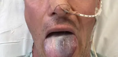 Cáncer por VPH casi le cuesta la lengua a Anthony Perriam: alerta para hombres