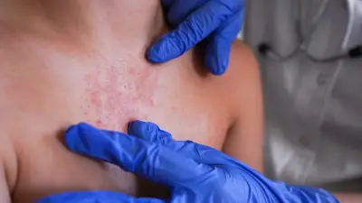 Durango confirma primera muerte por sarampión en 2026: niño de 8 años fallece