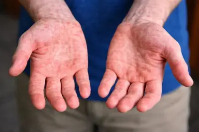 PAN Propone Comisión Especial en San Lázaro para Investigar Casos de Sarampión