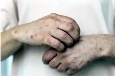 Robledo responsabiliza a gobiernos neoliberales por el resurgimiento del sarampión en México