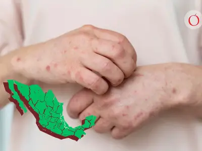 Sarampión en México: 7 estados concentran el 85% de los casos en 2026