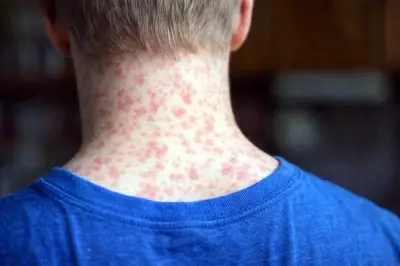 Sarampión en México: Se Elevan a 31 las Muertes Confirmadas por el Virus