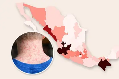 Situación actual del sarampión en México: casos por estado y alerta sanitaria