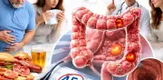 Factores de riesgo del cáncer de colon: ¿Quiénes deben estar más alerta?