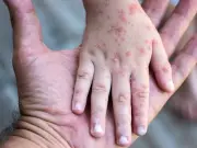 Mundial 2026 podría generar repunte de sarampión en México, advierte experto de UNAM