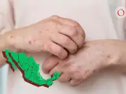 Sarampión resurge en México tras caída del 70% en gasto de vacunas