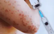 Sarampión en México: ¿Los adultos vacunados en la infancia necesitan revacunarse?