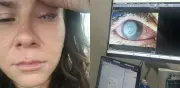 Tiktoker pierde visión por parásito y alerta sobre riesgos de lentes de contacto