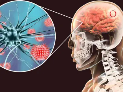 Brote de meningitis en Kent, Reino Unido, dispara alerta sanitaria tras muertes