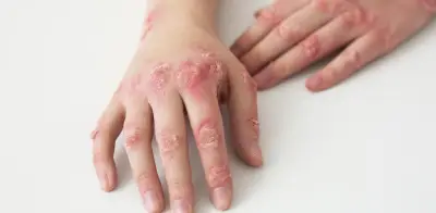 CDMX investiga tercera muerte posible por sarampión; confirman 418 casos