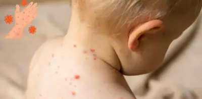 Confirman segunda muerte por sarampión en CDMX; bebé de 7 meses sin vacunar