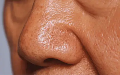 IMSS advierte sobre el síndrome de nariz vacía: olor fétido y pérdida de olfato