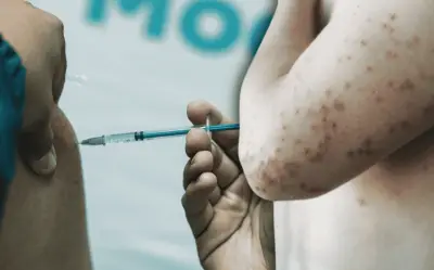 Jalisco reporta 600 casos activos de sarampión; autoridades destacan tendencia a la baja