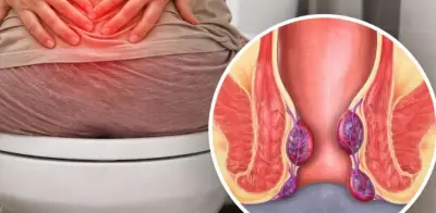 Picazón o dolor al evacuar: Hemorroides, causas y prevención explicadas