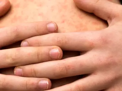 Sarampión resurge en México tras décadas de control: más de 11 mil casos en 2025-2026