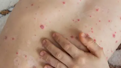 UNAM advierte: virus de la varicela puede reactivarse y causar herpes zóster en adultos