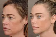 Denise Richards sorprende al revelar su procedimiento de estiramiento facial
