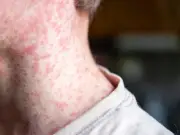 Jalisco reporta reducción significativa en contagios de sarampión y supera 2.5 millones de vacunas aplicadas