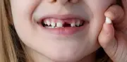Pérdida prematura de dientes de leche: consecuencias para la sonrisa permanente