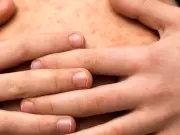 Sarampión resurge en México tras décadas de control: más de 11 mil casos en 2025-2026