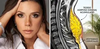 Famosos que enfrentan el Síndrome de Cushing y la 'joroba de búfalo'