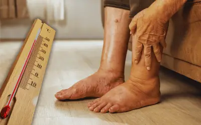 Hinchazón en Manos y Pies por Calor: Causas y Consejos para Aliviarla