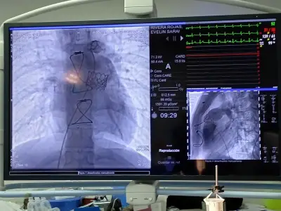 IMSS Coahuila realiza reemplazo valvular mínimamente invasivo a dos jóvenes