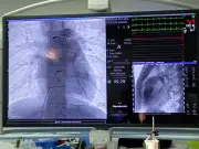 IMSS Coahuila realiza reemplazo valvular mínimamente invasivo a dos jóvenes