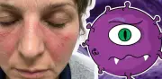 Lupus en mujeres: causas, síntomas y cómo detectarlo a tiempo