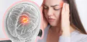 Dolor de cabeza: ¿cuándo puede ser síntoma de tumor cerebral?